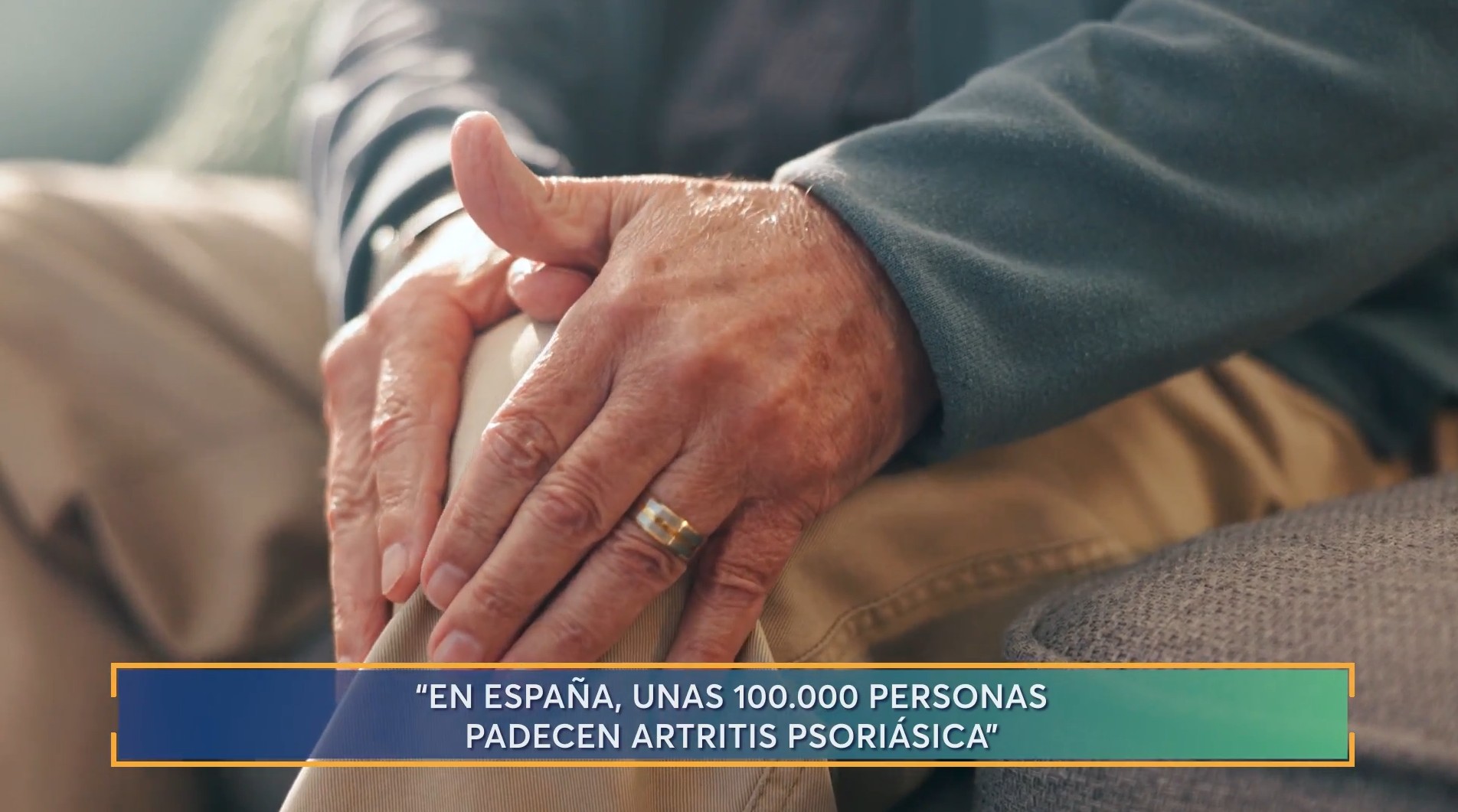 Artritis psoriásica