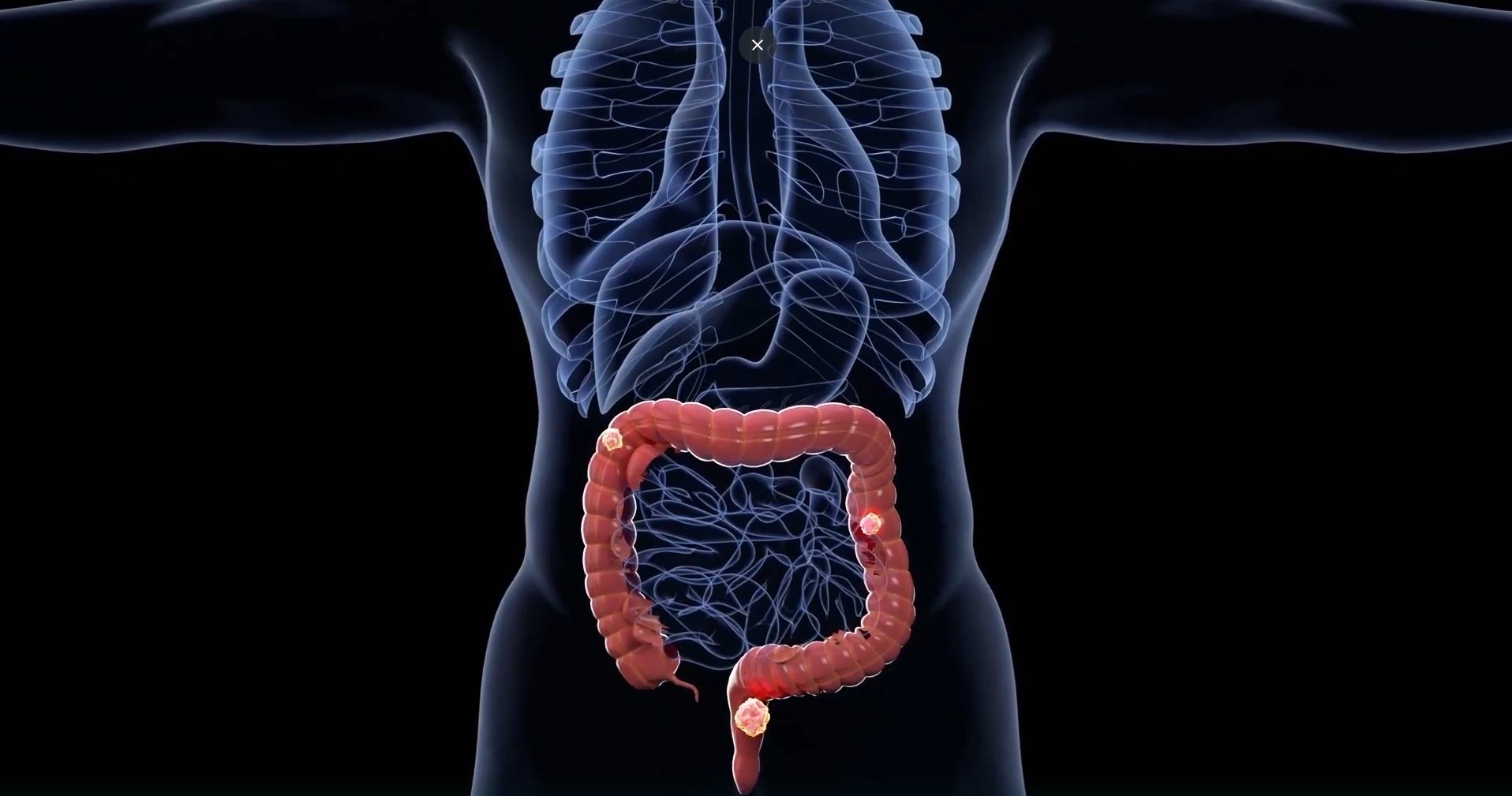 La enfermedad de Crohn